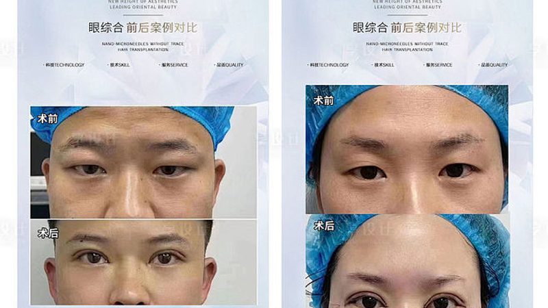 激光美容频率：揭秘最佳周期，让你的肌肤焕发光彩