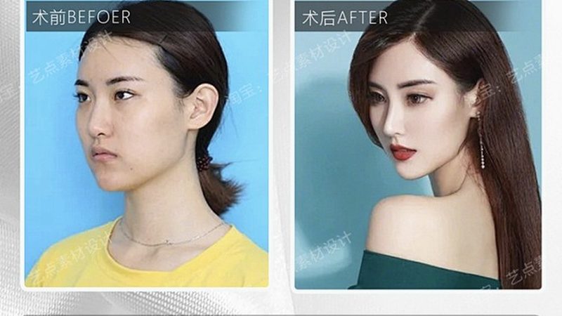 韩式三点双眼皮与全切双眼皮：揭秘两种术式的差异**