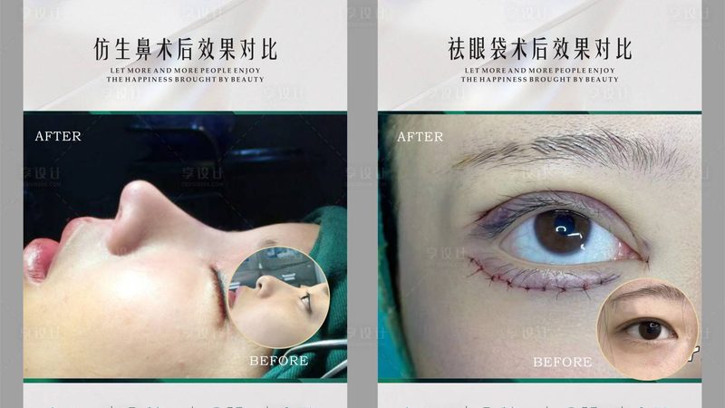 医用埋线提升线材加盟代理，你了解多少？**