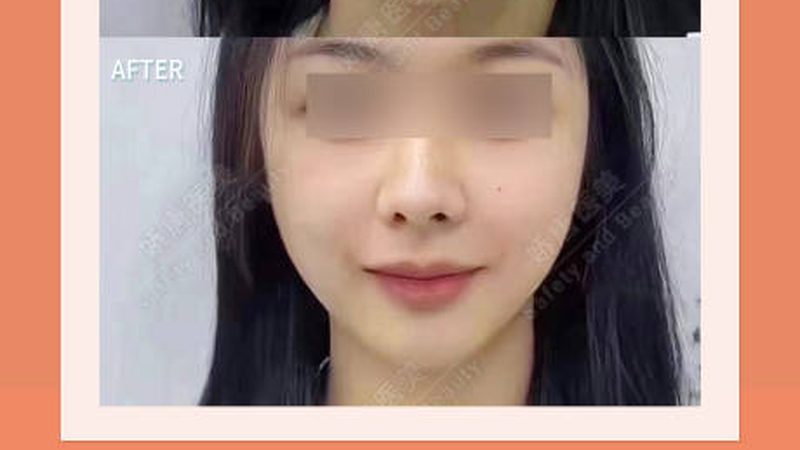 注射美容：揭秘禁忌症与适应症**