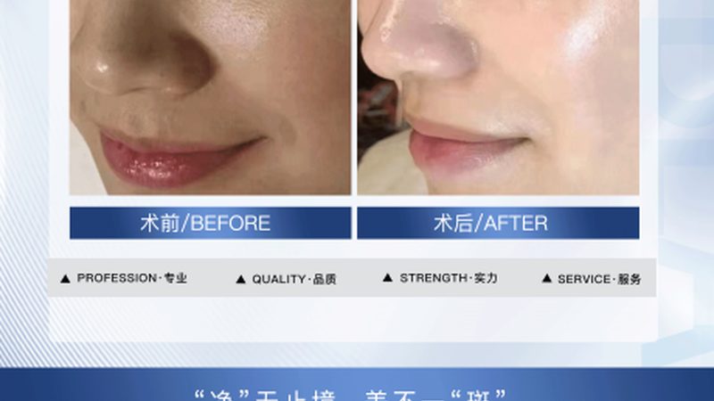 水光针与玻尿酸：揭秘两者维持时间的奥秘