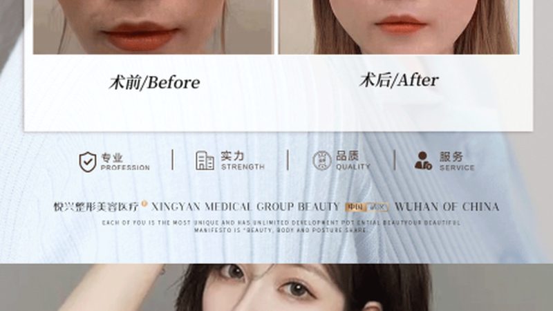 激光美容术后注意事项