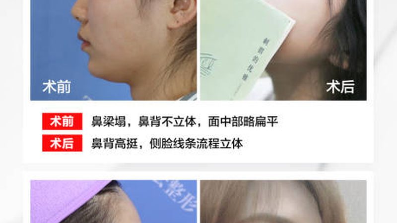注射美容适合什么年龄段最好