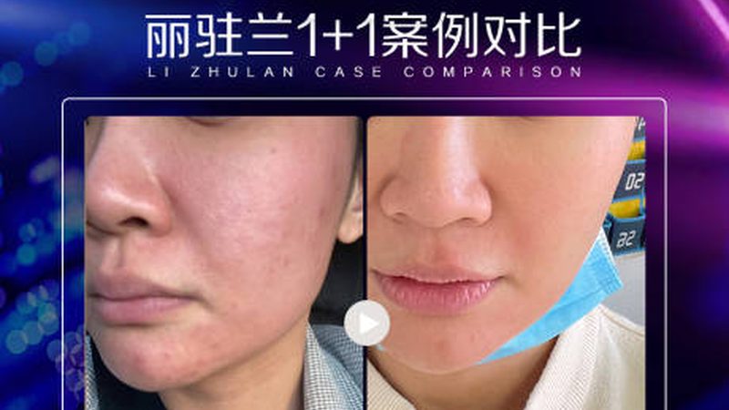 注射美容副作用不容忽视，真实案例揭秘风险与应对