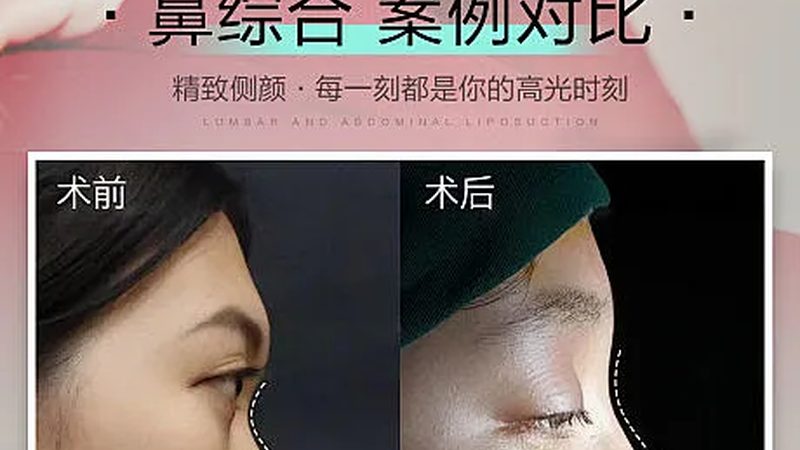 广州隆鼻价格：揭秘影响因素及合理预期