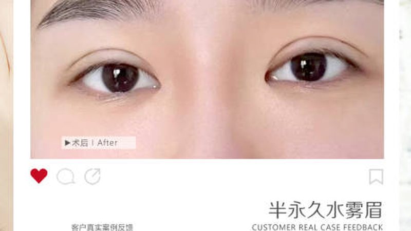 肉毒素提升与瘦脸针：揭秘两者间的异同