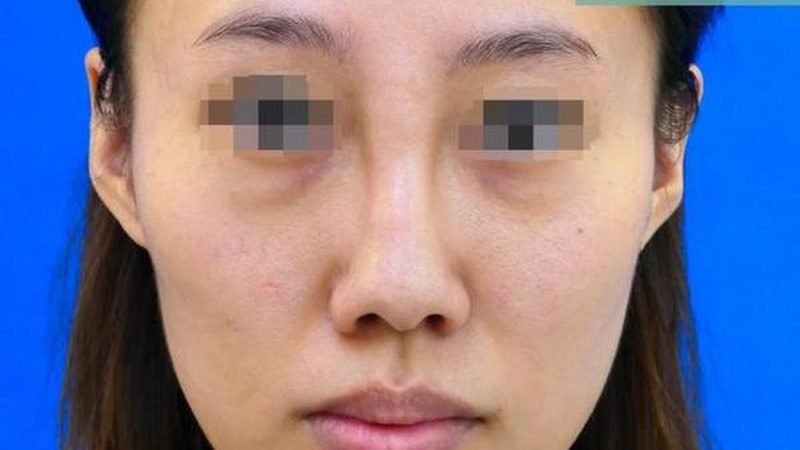 美容院打水光针和医院区别